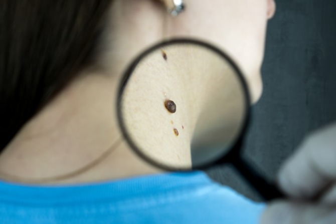 Dermatologist cancer prevention magnifying glass over suspicious neck moles examining A clinical Dermatologist uses a magnifying glass to perform a skin cancer screening, examining irregular moles on a patient's neck to identify early warning signs of melanoma.